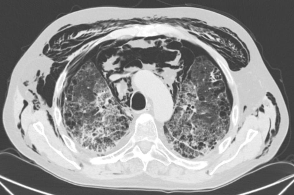 PNEUMOMEDIASTINO A Tomografia computadorizada (TC) de tórax tem também um papel importante no diagnóstico,