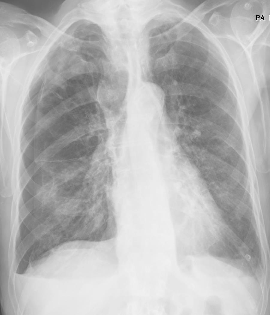 PNEUMOTÓRAX O exame mais frequentemente solicitado para o diagnóstico é a radiografia simples do tórax em pé, que tipicamente se caracteriza pelos seguintes achados: acumulação de ar