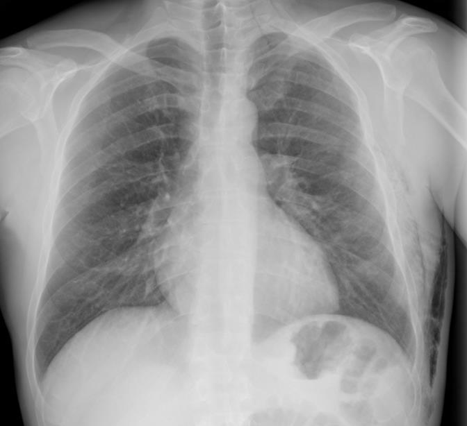 PNEUMOMEDIASTINO O diagnóstico de pneumomediastino é essencialmente radiológico. A Radiografia simples do tórax é um dos exames mais solicitados e um dos mais importantes para o diagnóstico.