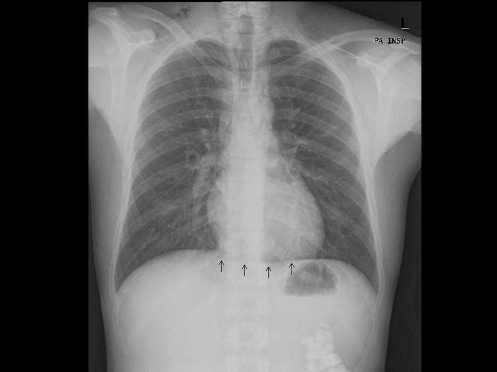 PNEUMOMEDIASTINO Alguns dos achados radiográficos são tão característicos que são sinais clássicos: Sinal do diafragma contínuo - representa uma linha radiotransparente (devido à interposição de uma