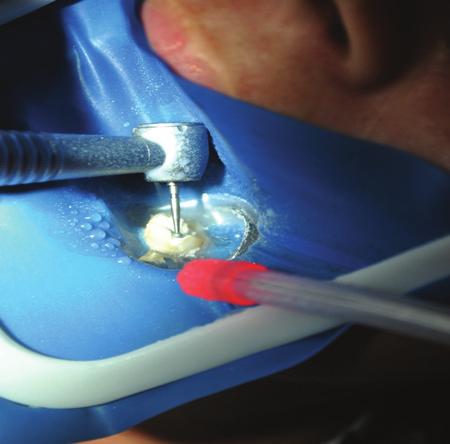 Na análise radiográfica, constatou-se uma restauração provisória extensa próxima ao tecido pulpar no dente 36, com ausência de comprometimento periapical