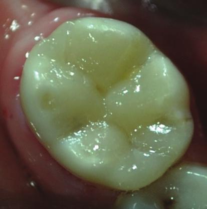 A radiografia final do tratamento foi realizada, sendo observados os seguintes aspectos: selamento do material em relação ao local da exposição pulpar e restauração de resina composta bem adaptada