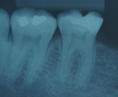 Obtido da seguinte forma: teste de cavidade ao frio realizado com Endo-Ice, onde a paciente respondeu de forma positiva.