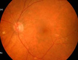 2 - ANOMALIAS CONGÉNITAS RETINIANAS Macrovasos retinianos Caracteriza-se pela