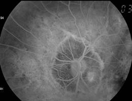 CV: Podem simular as alterações de CV do glaucoma.