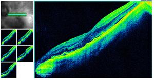 Descolamento seroso da retina associado em 40-50% dos casos. Fig. 2.