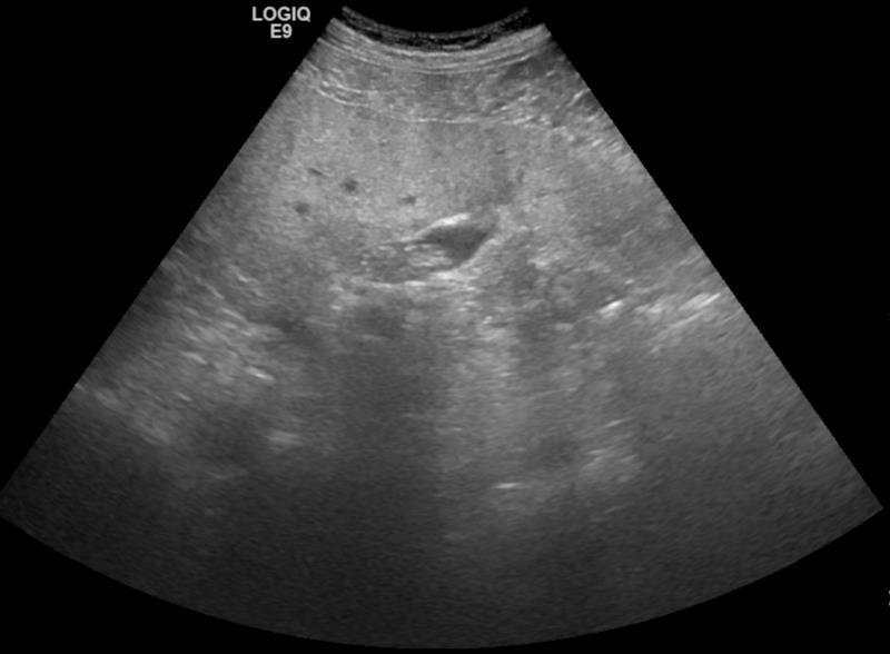 ALTERAÇÕES MORFOLÓGICAS DA CIRROSE HEPÁTICA A infiltração lipomatosa é um achado