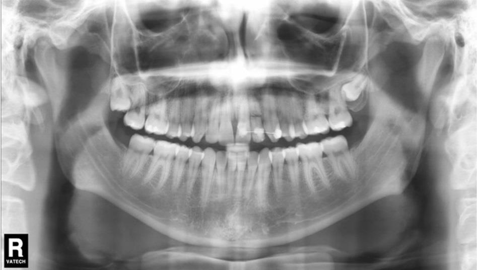 13 Figura 2: A) Radiografia Panorâmica; B) Linha radiolúcida no terço médio do dente 22 solução de continuidade/fratura radicular.