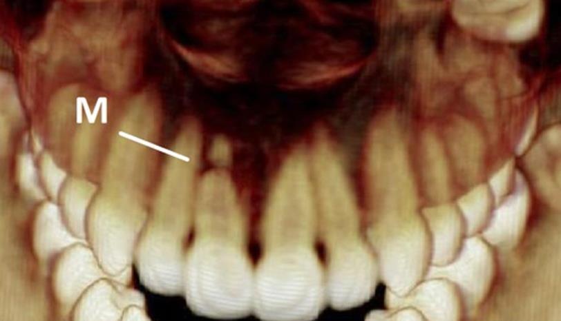 14 Fonte: Papaiz, 2014 Visando ser o melhor na odontologia a tomografia computadorizada de Cone Beam permite a visualização de pequenas partes da estrutura a ser analisadas e inibe a sobreposição de