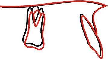 Componente Dentoalveolar Superior: FIGURA 19 Sobreposição (PP centrado em ENA) do traçado médio inicial (preto) e final (vermelho) do grupo Jasper Jumper.