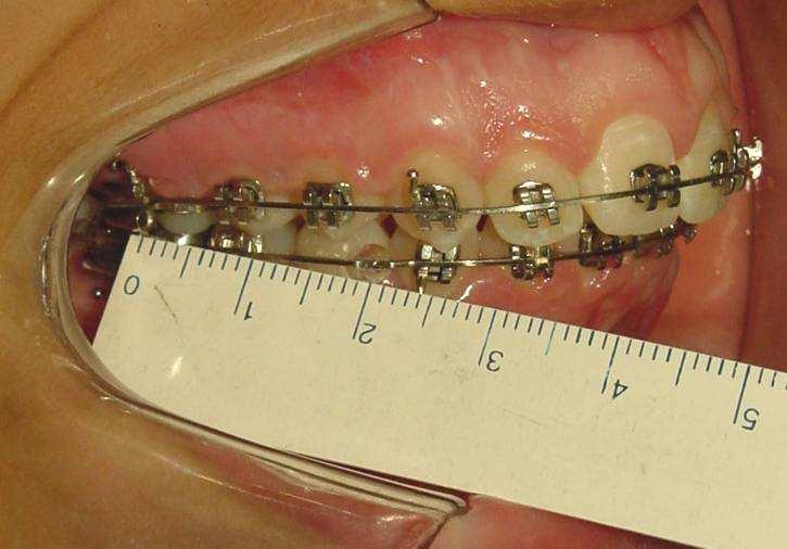 Material e Métodos 91 no arco superior para auxiliar na ancoragem dos molares, objetivando potencializar os efeitos esqueléticos e minimizar os dentários.
