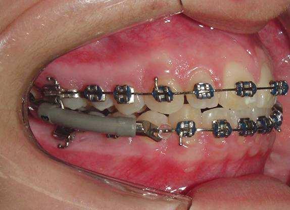 dispositivos de força e os braquetes dos pré-molares foram recolados, para um renivelamento até a fase de intercuspidação.