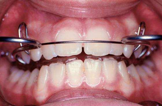 Material e Métodos 95 FIGURA 6 Aparelho Ativador conjugado ao extrabucal instalado Ortodontia corretiva: Após a obtenção de uma