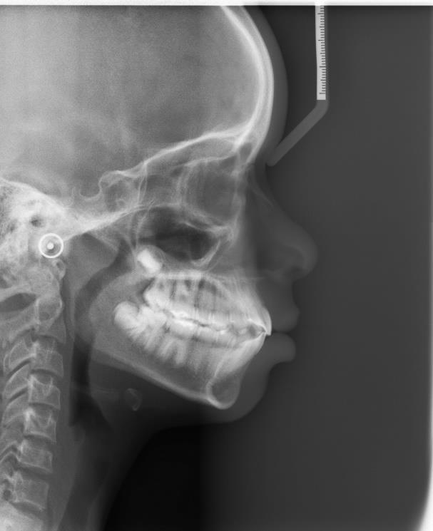 presença de material restaurador na coroa dos dentes 16, 13, 22, 26, 36, 34 e 46.