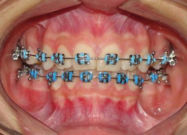 2 Tratamento Para a execução desse tratamento foi realizado a extração de 4 pré-molares, sendo dois superiores e dois inferiores.