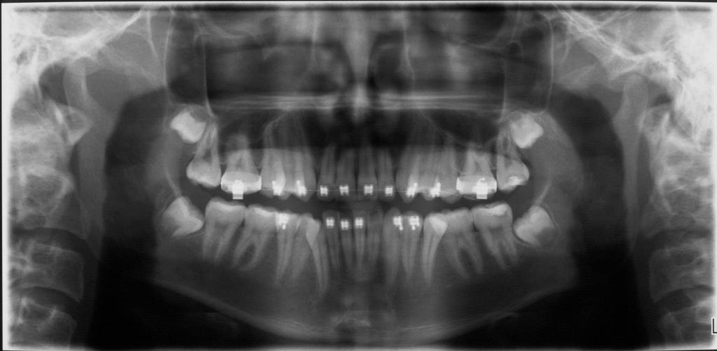 dentoalveolares, presença de aparelho fixo, e terceiros molares superiores e inferiores em