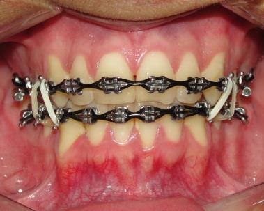 Ao verificar a correta relação em classe I dos caninos, foi realizada a intercuspidação dos dentes utilizando elástico 1/8 de