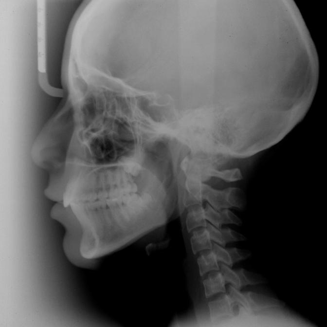 Figura 16. Radiografia cefalométrica final. Figura 17. Radiografia panorâmica final.