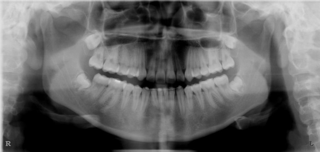 apinhamento intra-arco, mas também o efeito previsto do tratamento na protrusão labial, quantidade de overbite presente, estado periodontal do paciente e existência de dentes perdidos ou