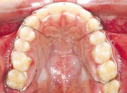 Para que isso ocorra, é necessária a manutenção dos dentes em suas posições ideais por um período de tempo.