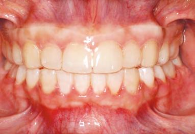 Para evitar movimentos dentários indesejáveis, as contenções maxilares e mandibulares são