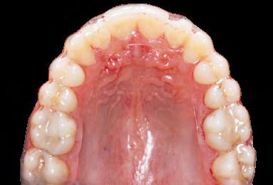 Esses aparelhos de contenção, somente, controlam os posicionamentos dentários intra-arco.