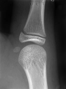 (A) (B) (C) FIGURA 5 O acompanhamento longitudinal por meio de radiografias do dedo polegar reitera o conceito de que o pico de crescimento, identificado na presente pesquisa pelo capeamento