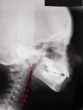 19 Revisão de literatura Nesse contexto, o ortodontista passou a perceber estruturas presentes na telerradiografia em norma lateral que pudessem indicar o estágio maturacional do paciente.