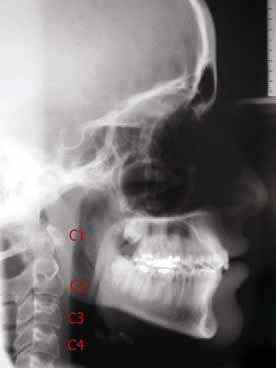 1 Realizada com este escopo, a telerradiografia em norma lateral fornece inclusive a imagem das sete vértebras cervicais ou de pelo menos das quatro primeiras, nos casos em que o paciente estiver