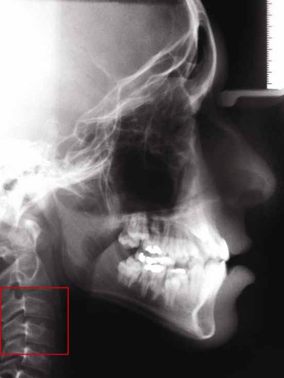 32 Material e método FIGURA 14 Telerradiografia em norma lateral de um paciente do grupo amostral.