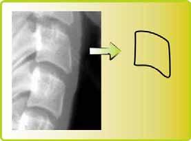 37 Resultado (E) FIGURA 15 Morfologia das vértebras cervicais visualizada nas telerradiografias. O formato da 3ª vértebra foi esquematizado com o intuito de facilitar sua apreciação.