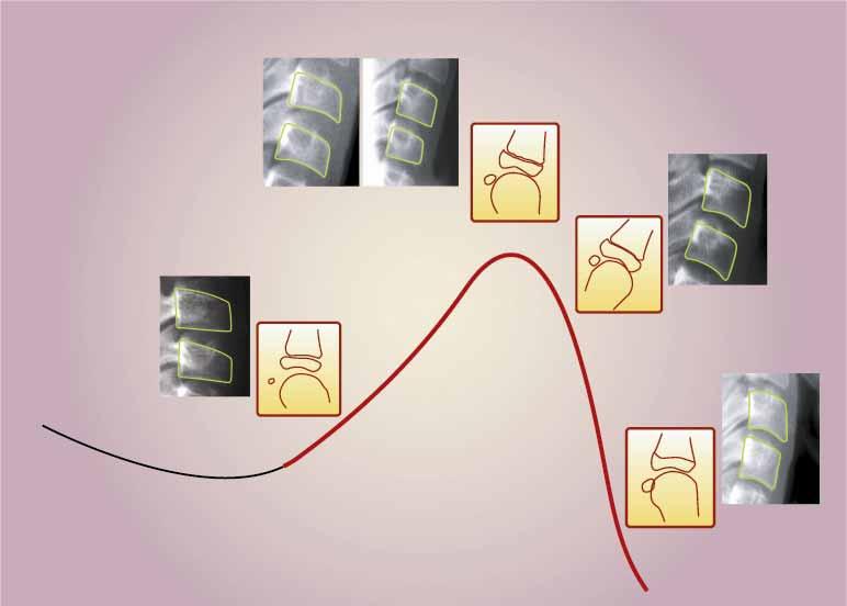 48 Discussão FIGURA 17 As diferentes morfologias encontradas em C3 e C4 foram dispostas sobre o gráfico do surto de crescimento da adolescência, facilitando sua visualização.