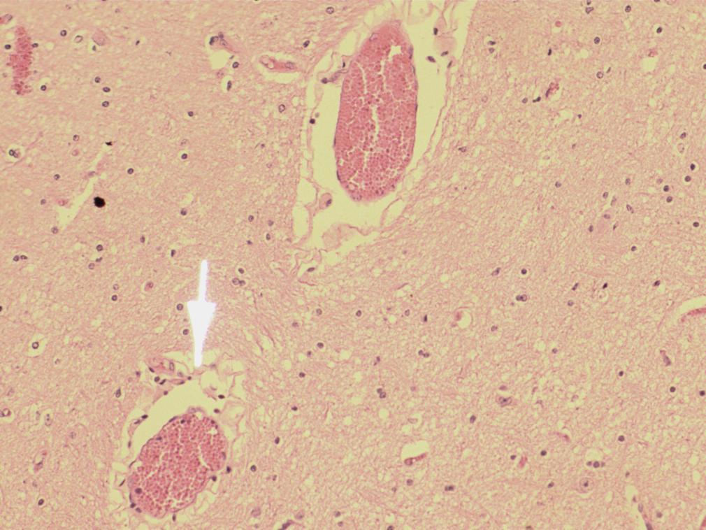 59 Figura 12 Corte histológico de SNC (4 m): congestão e edema do neurópilo (aumento 200x).