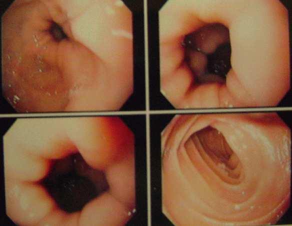 21 FIGURA 2 - Endoscopia normal na cirurgia de Capella Segundo Freeman (28) o endoscopista deve dar atenção à mucosa esofágica, ao tamanho, aspecto e integridade da bolsa gástrica, especialmente na