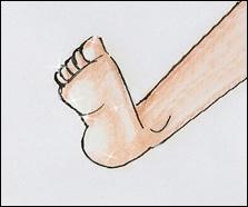 sobre o dorso do pé, unhas do hállux espessadas, pele brilhante descamativa),