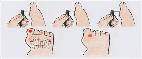 sensoriais cutâneas nos pés, podendo ocasionar transtornos da estrutura osteoarticular dessa região, além de contribuir para modificar a marcha, o equilíbrio estático e dinâmico (DUARTE, GONÇALVES,