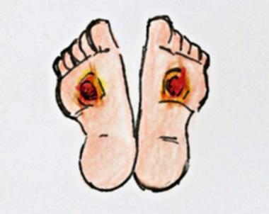 Existem muitas evidências de que pessoas com neuropatia diabética muitas vezes usam calçados menores afim de aumentar a sensação de ajuste.