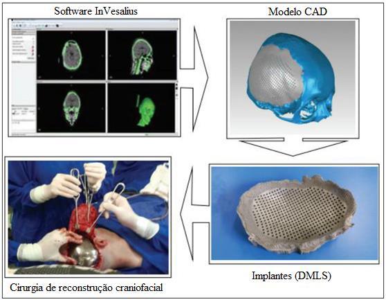 37 A técnica de manufatura aditiva DMLS (sinterização direta de metal por laser), é uma das mais utilizadas na fabricação de biomodelos e próteses para utilização médica e odontológica.