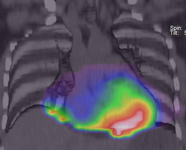 Discussão: As características clínicas da Miocardiopatia de Takotsubo são: início súbito de dor anginosa, alterações eletrocardiográficas e elevação discreta de marcadores de necrose miocárdica,