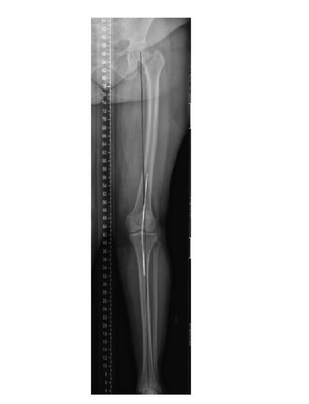 13 Figura 1 - A- Radiografia panorâmica do membro inferior. B- Eixo mecânico/alinhamento neutro, reta traçada do centro da cabeça femoral ao centro da articulação do tornozelo.