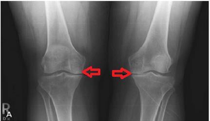 15 Figura 3 - Radiografia na incidência anteroposterior com carga, seta evidenciando o acometimento medial da osteoartrite Fonte: Próprio autor Outra forma de avaliarmos o eixo do membro inferior é