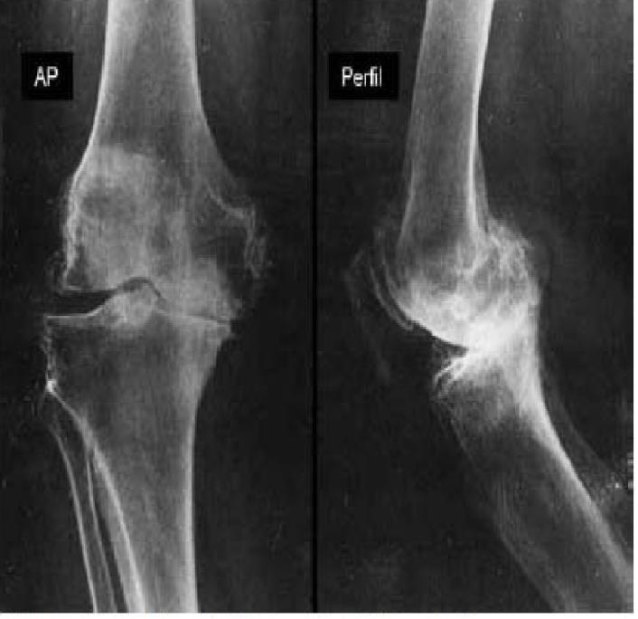 18 Figura 6 - Radiografias nas incidências AP e Perfil com carga evidenciando osteoartrite.