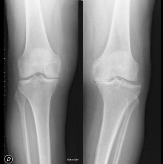 20 Figura 8 - Radiografia em AP do joelho com a técnica correta, captando devidamente substrato diafisário femoral e tibial suficientes para se traçar o eixo anatômico Fo Fonte: Próprio autor Na