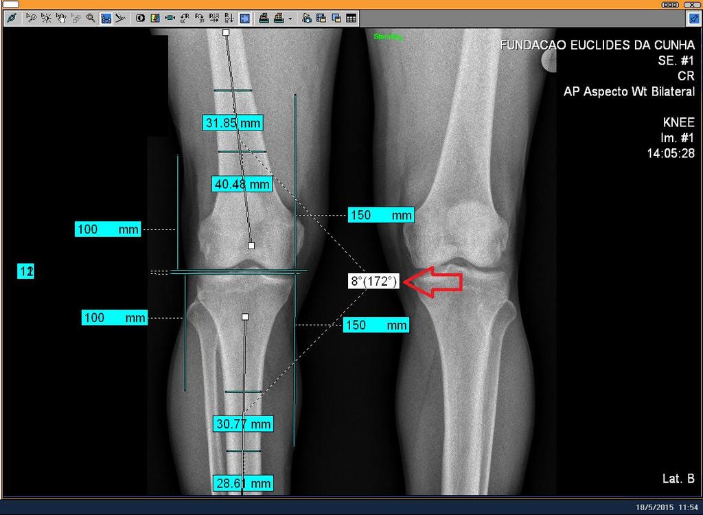 32 Figura 13 - Método aplicado para a aferição do eixo anatômico do joelho na incidência em AP com apoio bipodal, utilizando o sistema visualizador de imagens Phillips e as ferramentas de ângulos