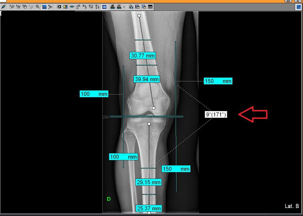 33 Figura 14 - Método aplicado para aferição do eixo anatômico do joelho na incidência em AP com carga e apoio monopodal, utilizando as ferramentas do programa visualizador de imagens Phillips.