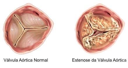 Sinais ou sintomas e/ou doença cardiovascular, metabólica, ou renal 8- Murmúrio no