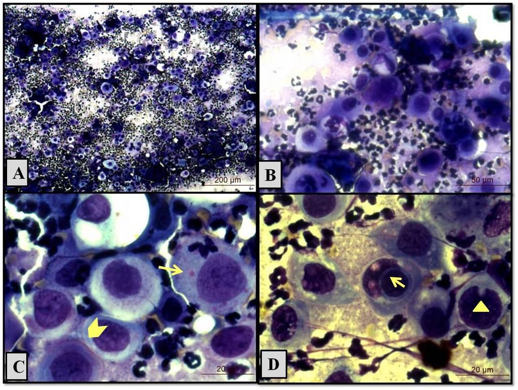 5 FIGURA 1- A) Fotomicrografia do CCE à citologia. Acentuado infiltrado neutrofílico e células epiteliais neoplásicas dispostas isoladamente ou em pequenos grupos (Objetiva 10x).