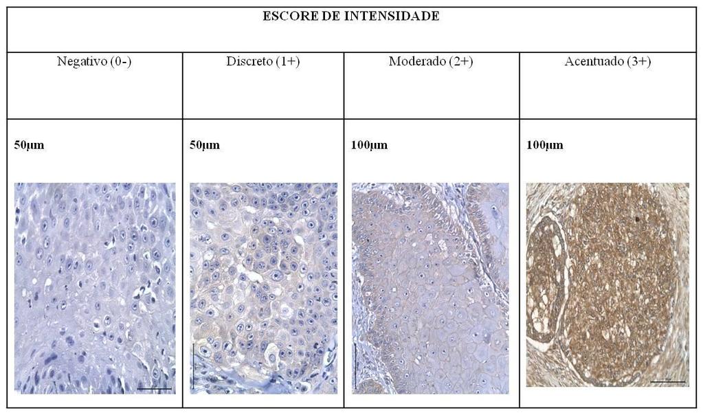 20 Para a avaliação da distribuição da imunomarcação de EGFR e c-erbb2 foi utilizada uma pontuação adaptada de Looper et al. 20, Hendrix e Newkirk 35, Bilous et al. 45 e Sabattini et al.