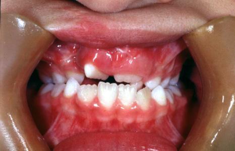 Relação entre os arcos dentários pobre com trespasse horizontal negativo e inclinação dos incisivos superiores