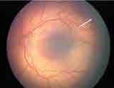 Tufos isolados de neovasos na superfície retiniana
